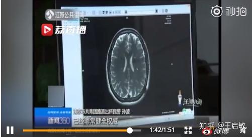 后天精神病遗传几率有多大(后天精神病遗传几率是多少)