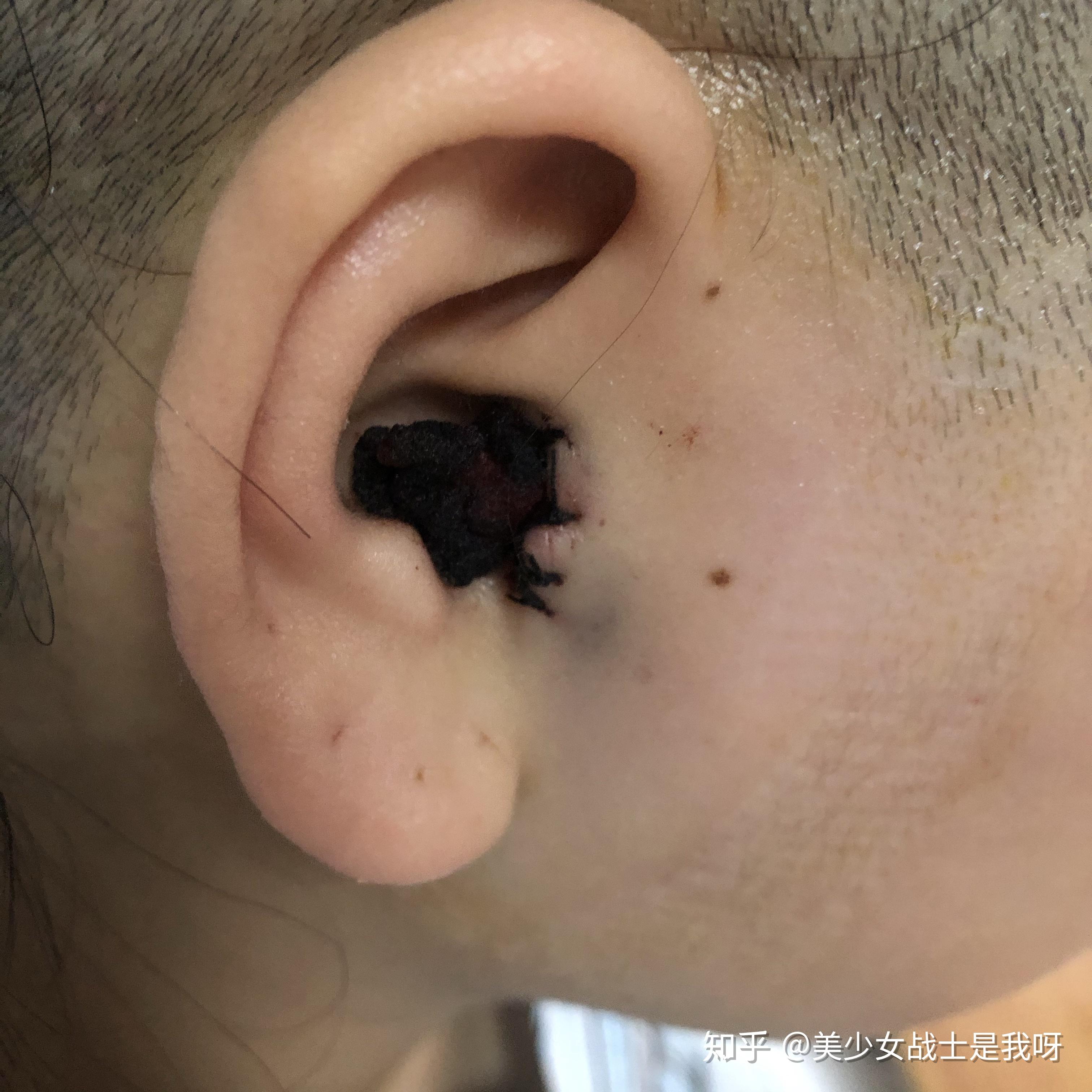 鼓膜穿孔修补手术有人了解么具体有哪些风险