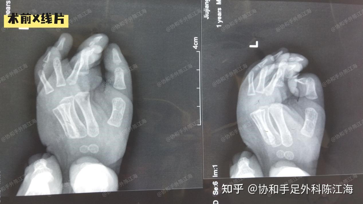 并指免植皮 | 案例20《左手张开了，双手差别缩小了！》 - 知乎