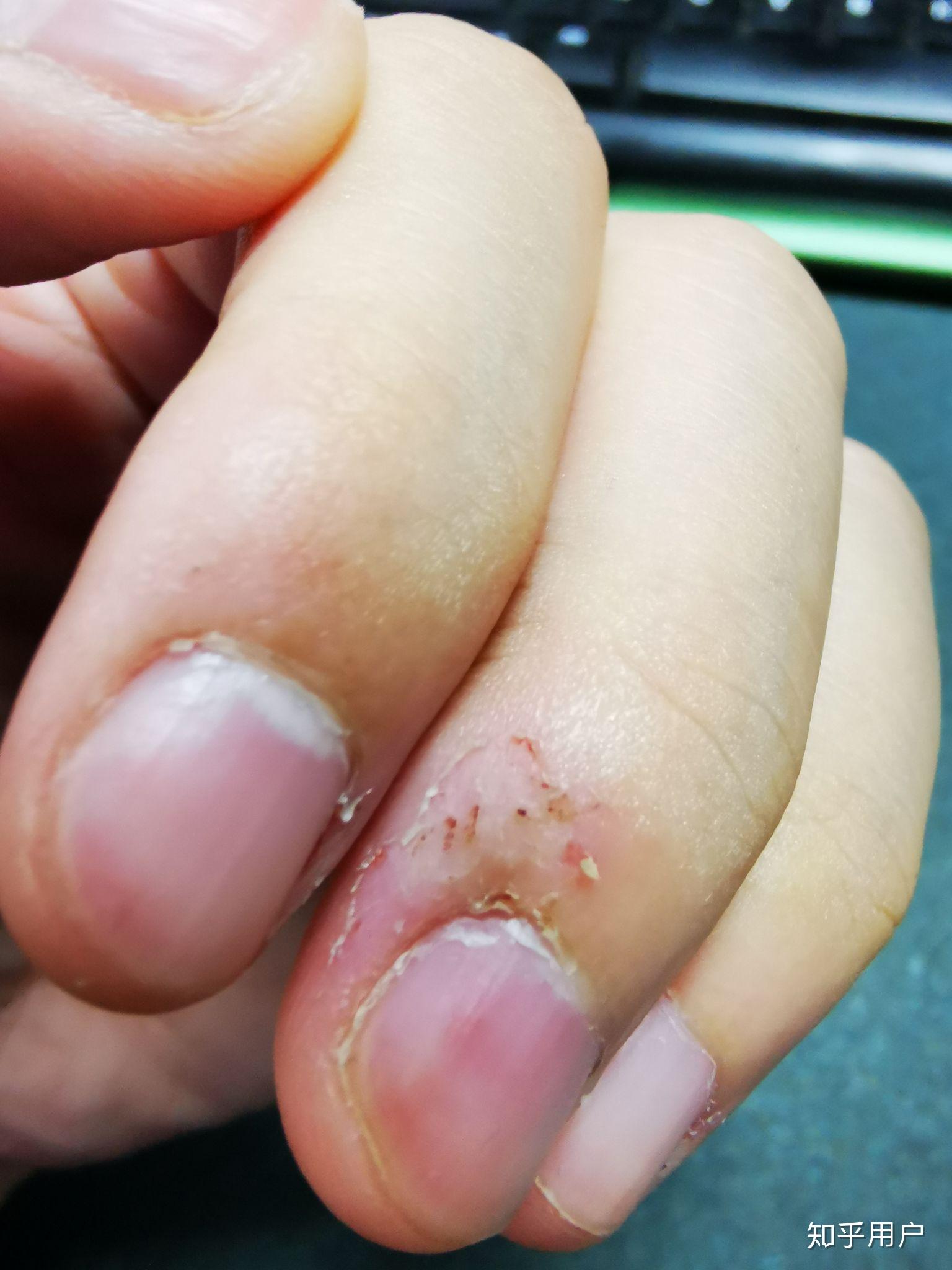 咬手皮是一种怎样的心理?