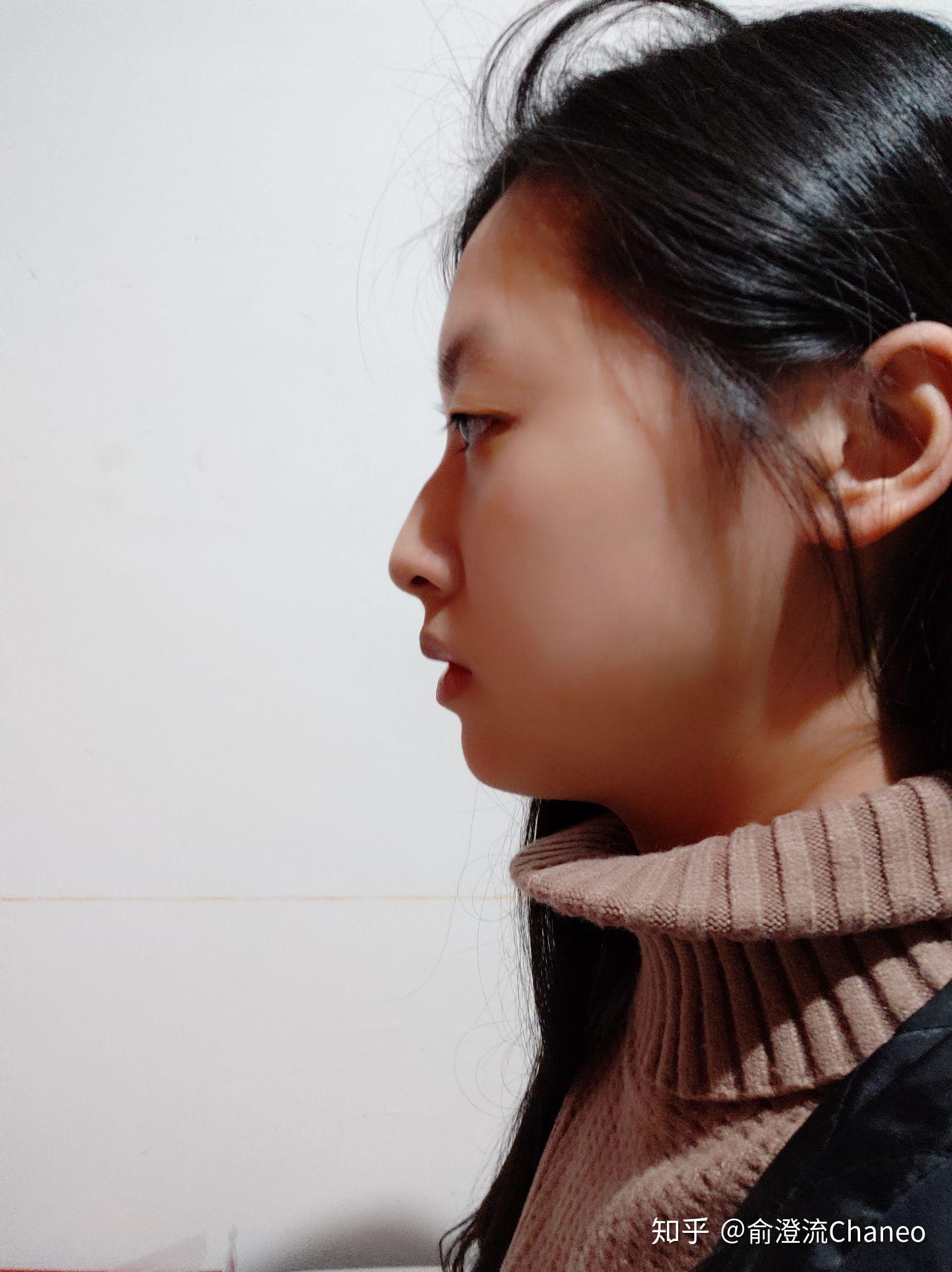 侧面看眼睛非常突,眉骨低和鼻子连接不起来是怎么回事?