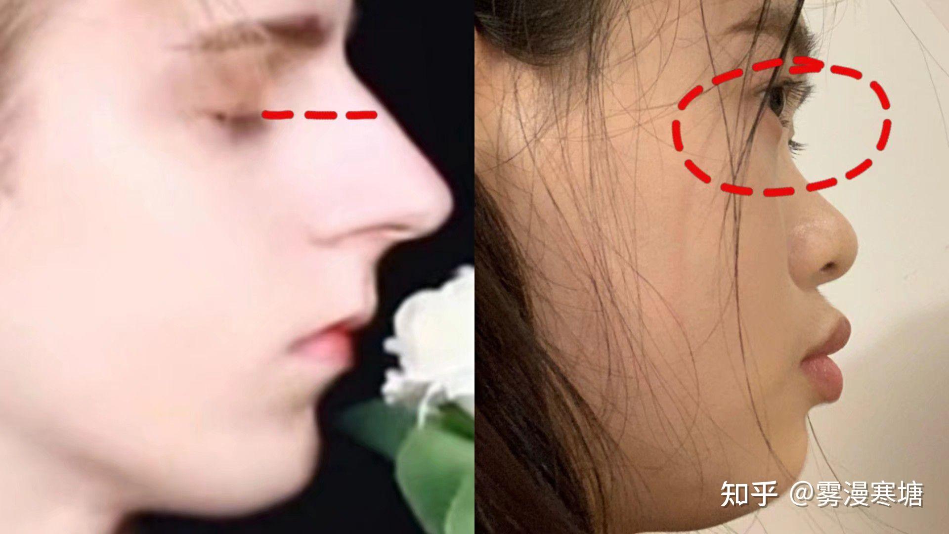 鼻子高但是山根低是什么样? - 知乎