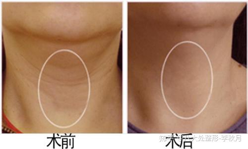 脖子脂肪多从小就有颈纹得人怎么淡化颈纹呀