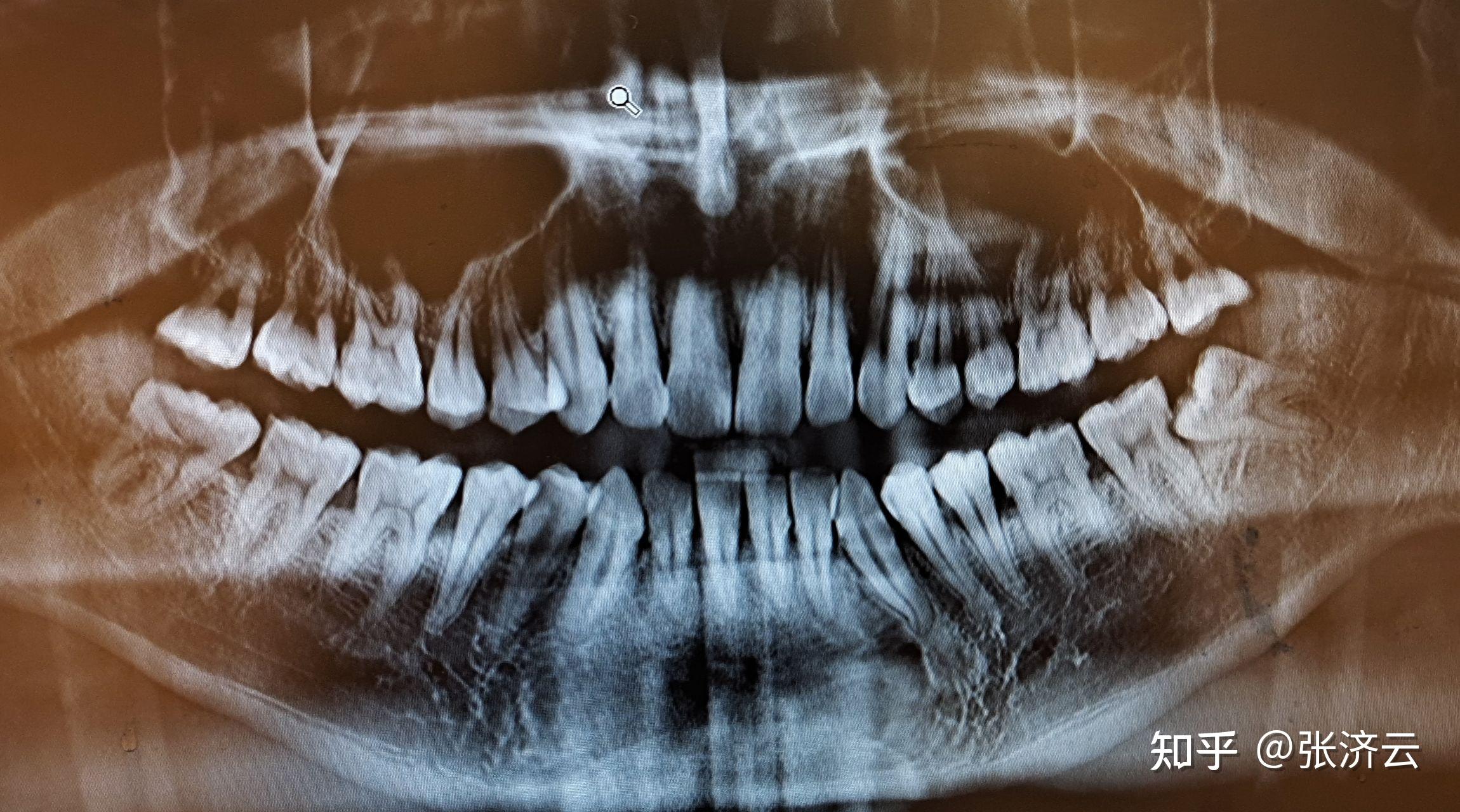 龈下刮治后悔吗