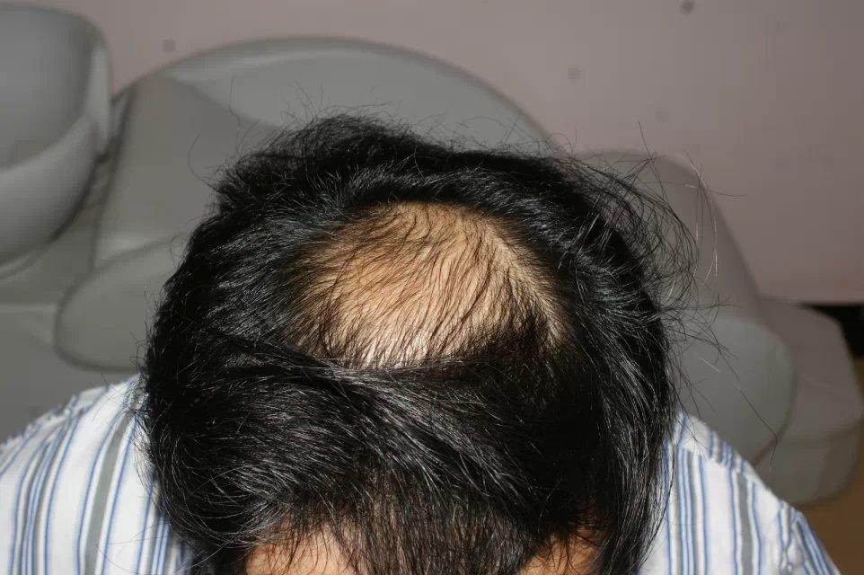 为什么即使挡不住秃顶秃顶的人还是喜欢把两边的头发梳到中间