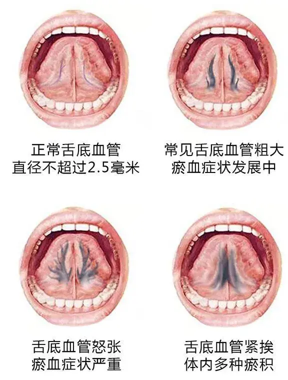 舌下青筋有淤黑血瘀体质的人怎么预防