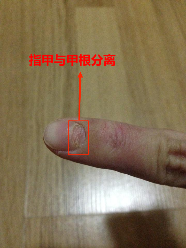 是灰指甲的症状吗? 该如何治疗? - 知乎