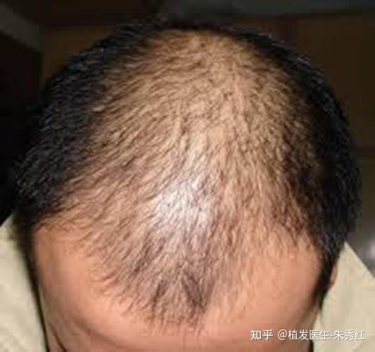 发量少适合植发吗? - 知乎