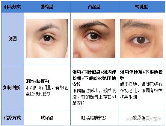 有针对性解决不同类型的「泪沟」方法,教你摆平它 - 知乎