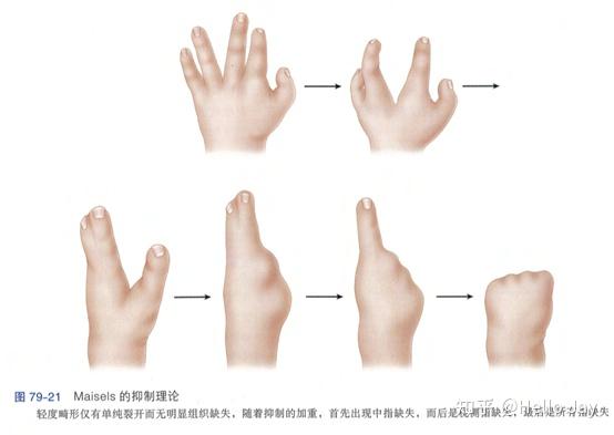 先天性手部畸形-形成障碍(发育停止) - 知乎