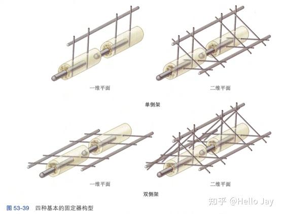 骨折固定的生物材料、内植物设计和骨折固定的生物力学 - 知乎