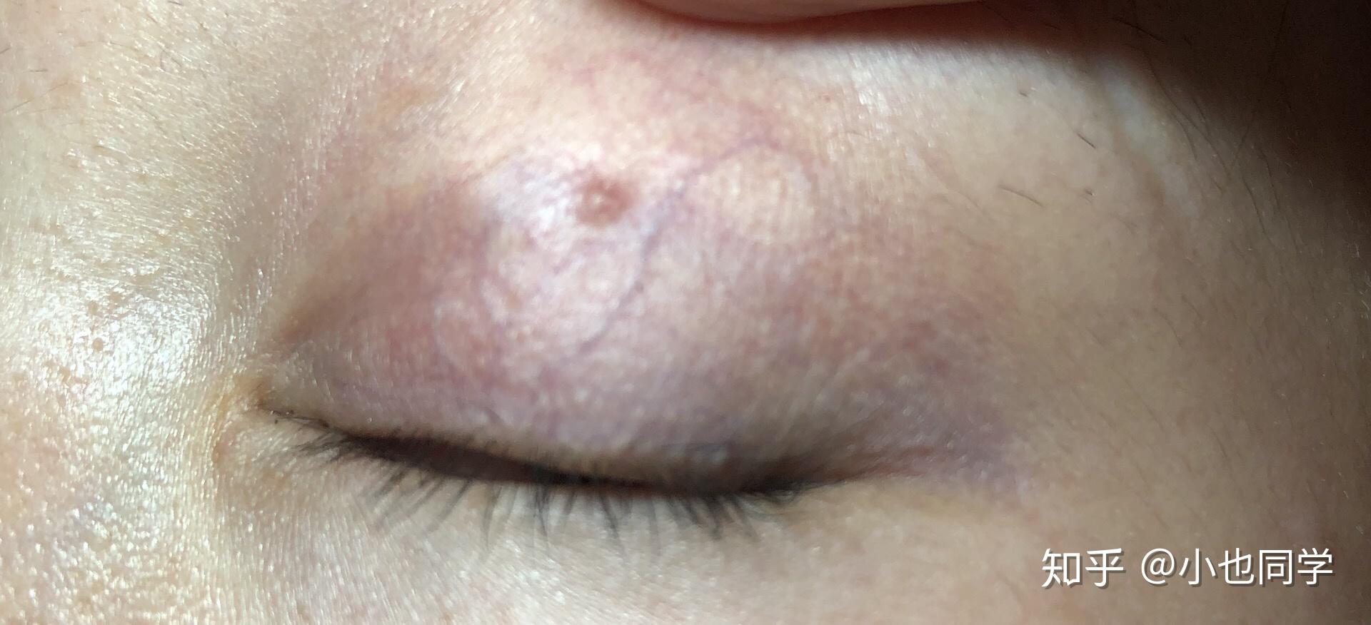 埋线双眼皮手术后眼皮上有小疙瘩能自行吸收吗