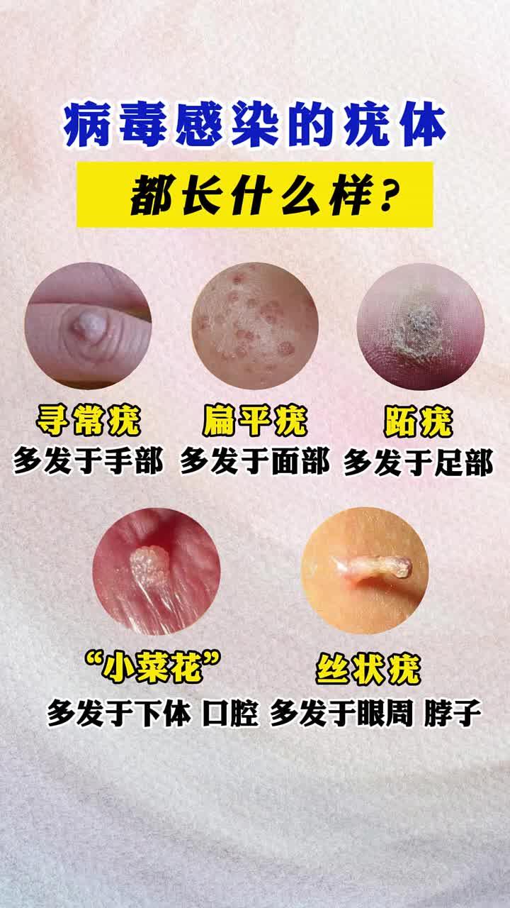 hpv感染的疣体长啥样,快来对照一下,你是属于哪种?