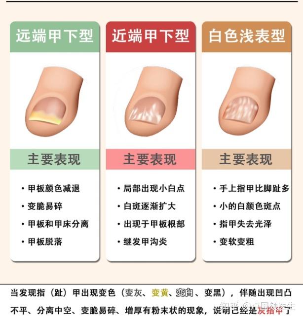 灰指甲究竟是什么病?医生:主要是真菌感染,治疗难点有二! - 知乎