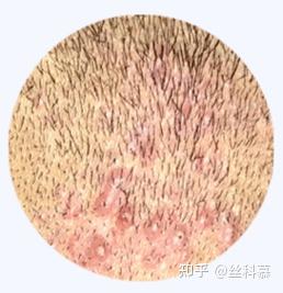植发后为何会产生毛囊炎?一招教你避免! - 知乎
