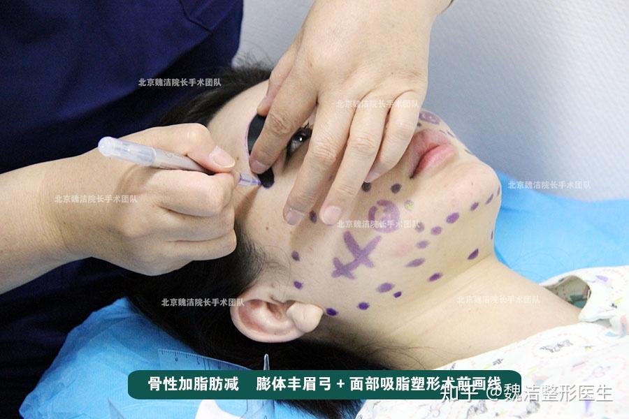 膨体眉弓假体雕刻的核心需尊重眉骨生理结构、契合美学规律 呈现弧度弯曲顺延眶骨缘 北京魏洁 - 知乎
