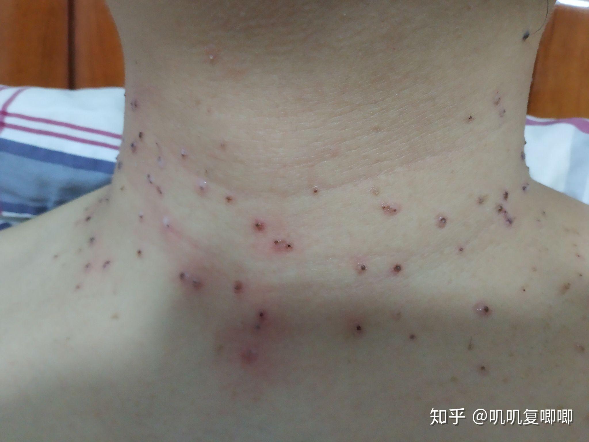 丝状疣脖子上女性医生说要激光扫有别的办法吗