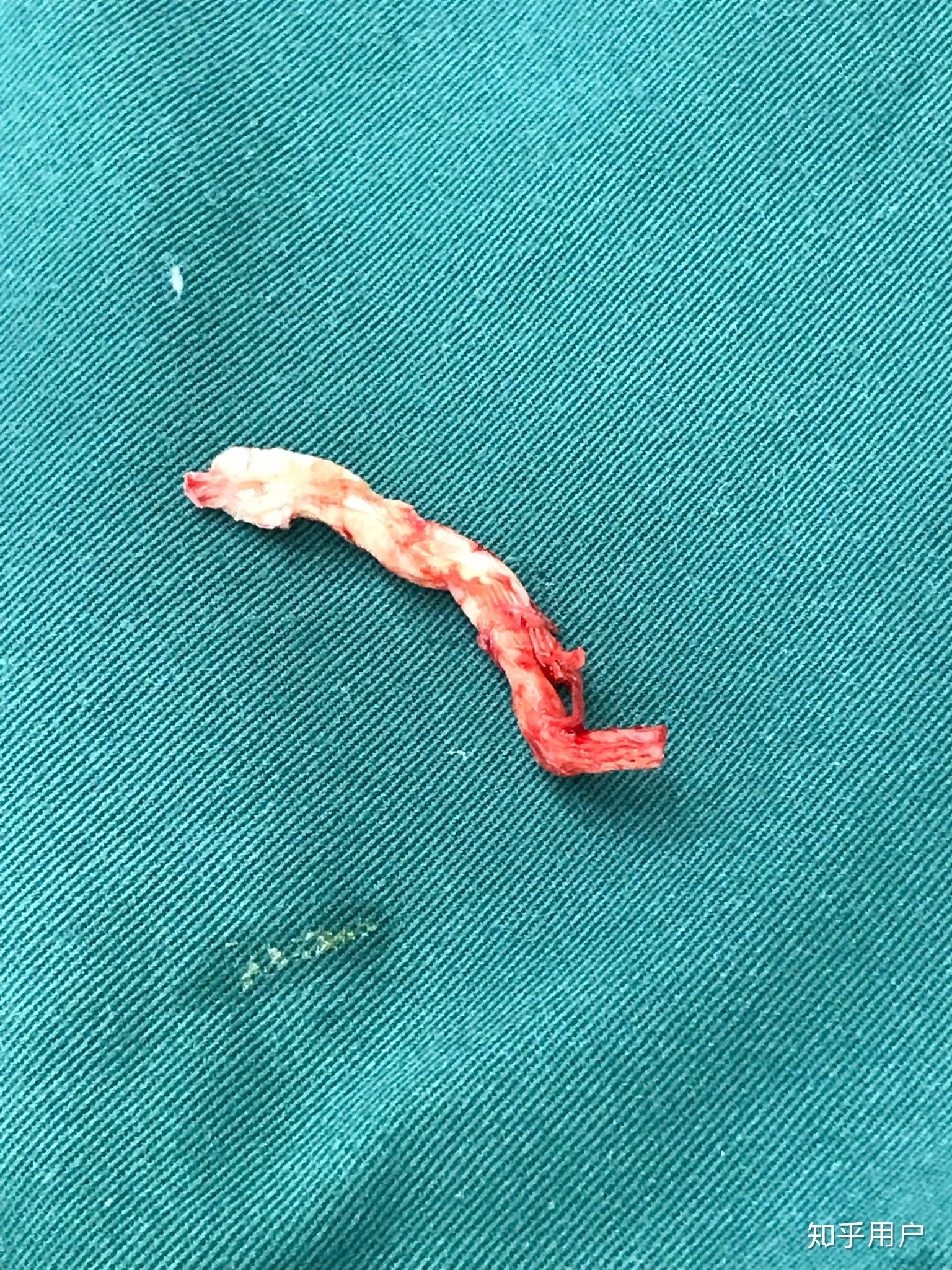 有做过膨体假体取出的人吗? - 知乎