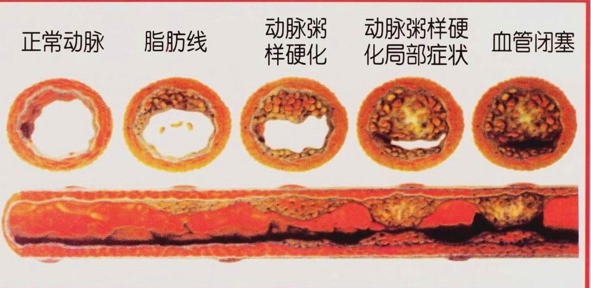 血管硬化不可逆!动脉硬化有4个阶段,早一步发现早预防! - 知乎