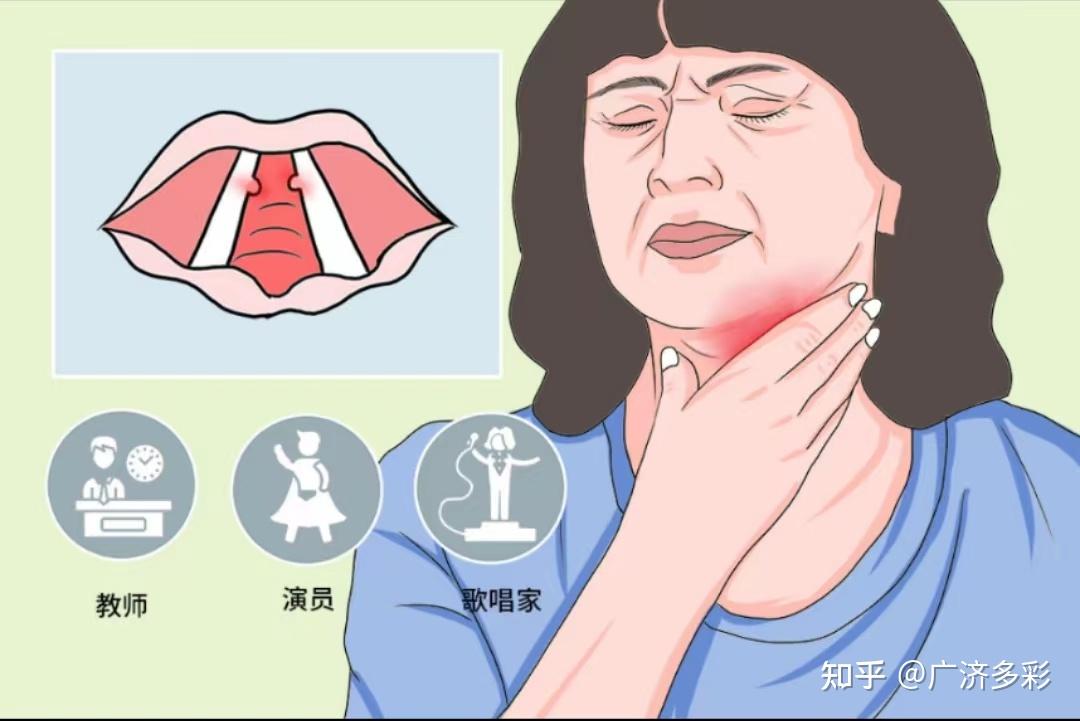 声带小结是长什么异物了吗?我们该怎么办 - 知乎