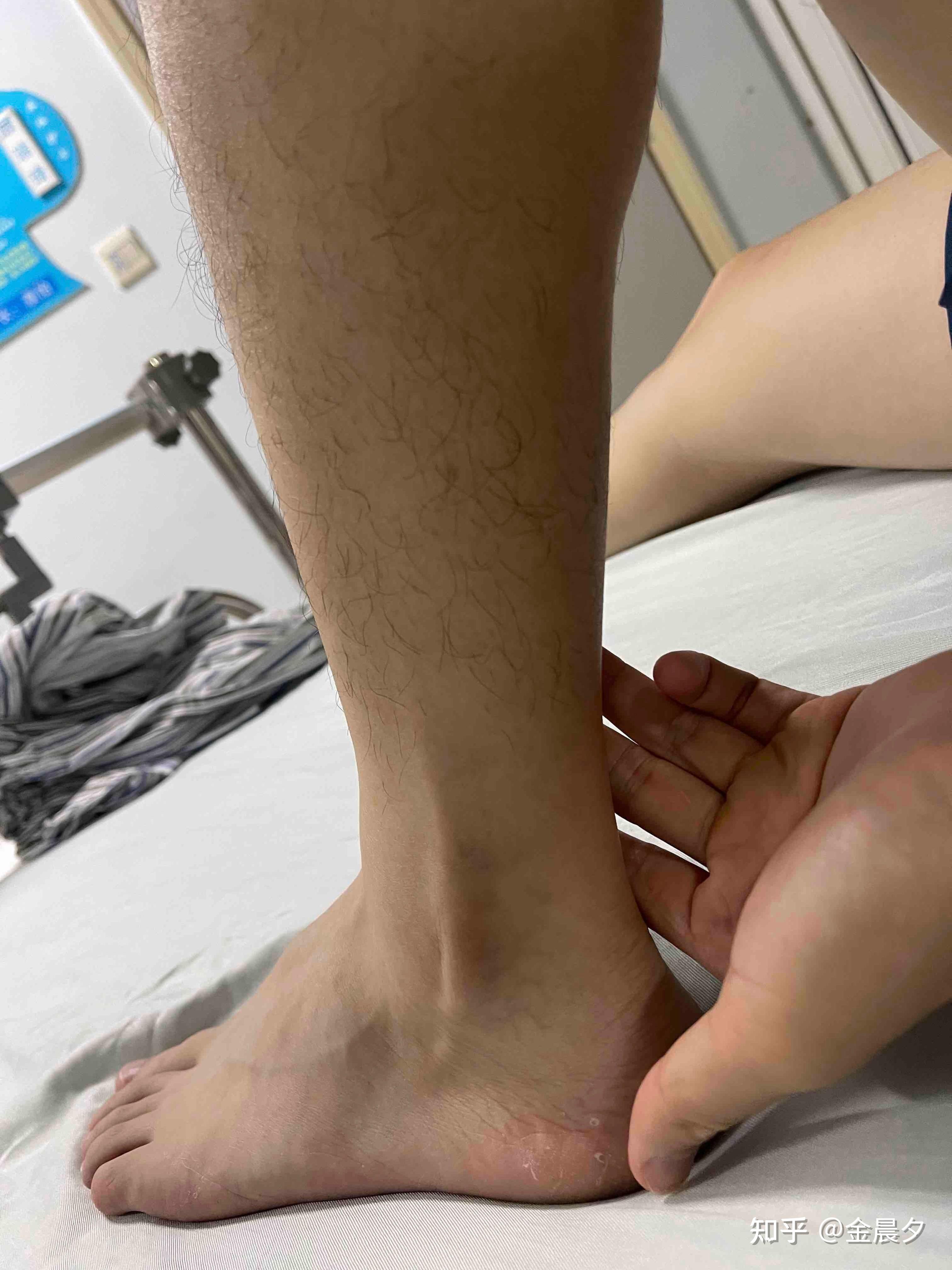登录/注册 骨科 运动损伤 脚踝 韧带磨损 脚踝扭伤 腓骨肌腱滑脱?