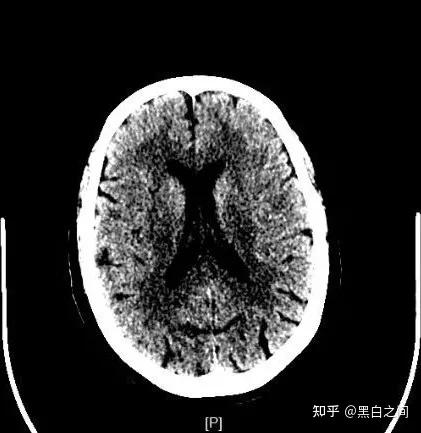 CT窗口技术原理及应用方法 - 知乎
