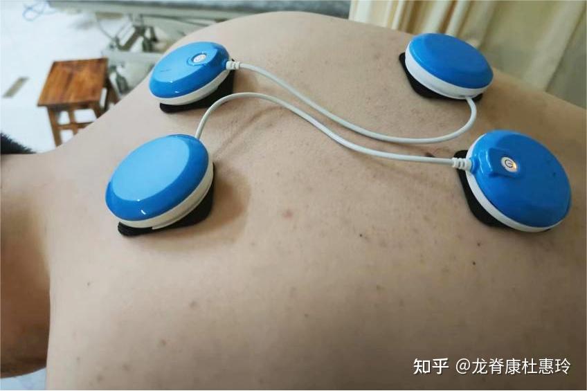 脊柱侧弯患者,治疗两次后剃刀背从5°减至1°,体态恢复正常 - 知乎