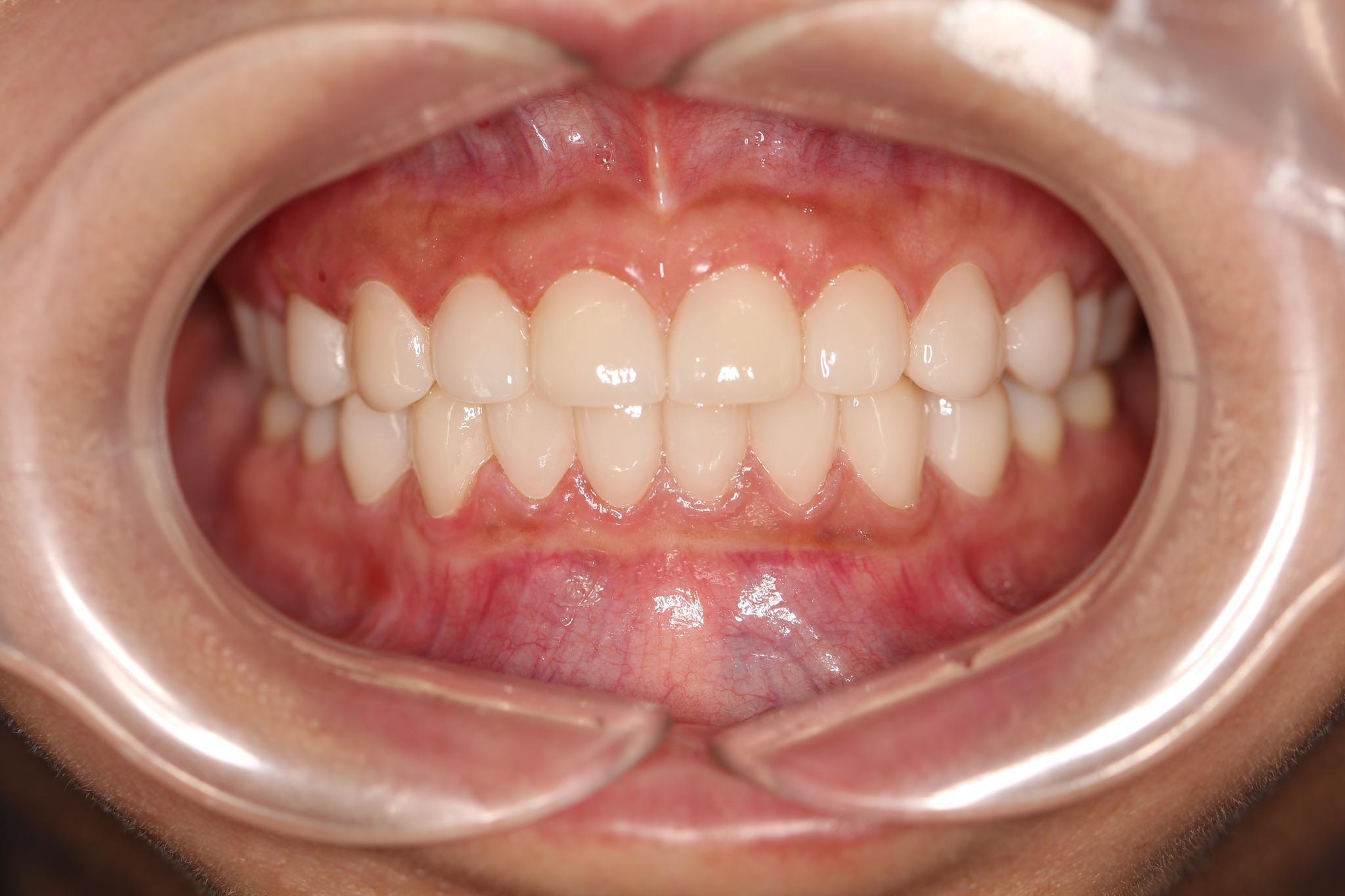 都三十岁的人了,牙列不齐牙缝大这些问题还能矫正吗? - 知乎