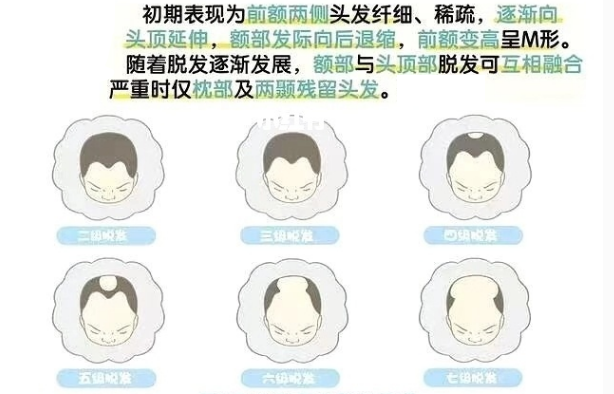 为什么男人更容易脱发?脱发分七级,你在哪一级?治疗方法看这里! - 知乎