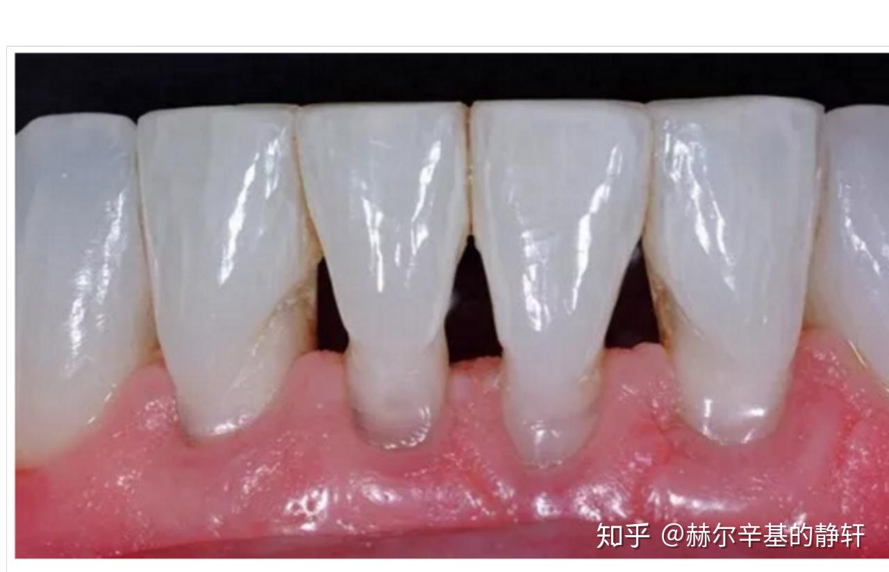 有没有正畸结束后黑三角比较明显的? - 知乎