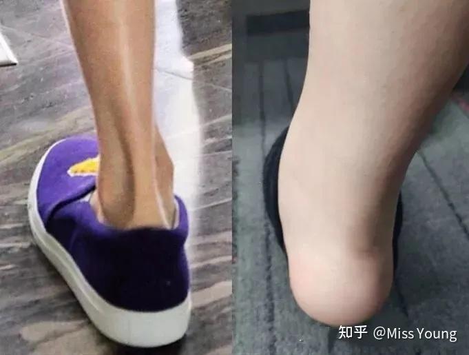 女生脚踝粗是基因决定的吗