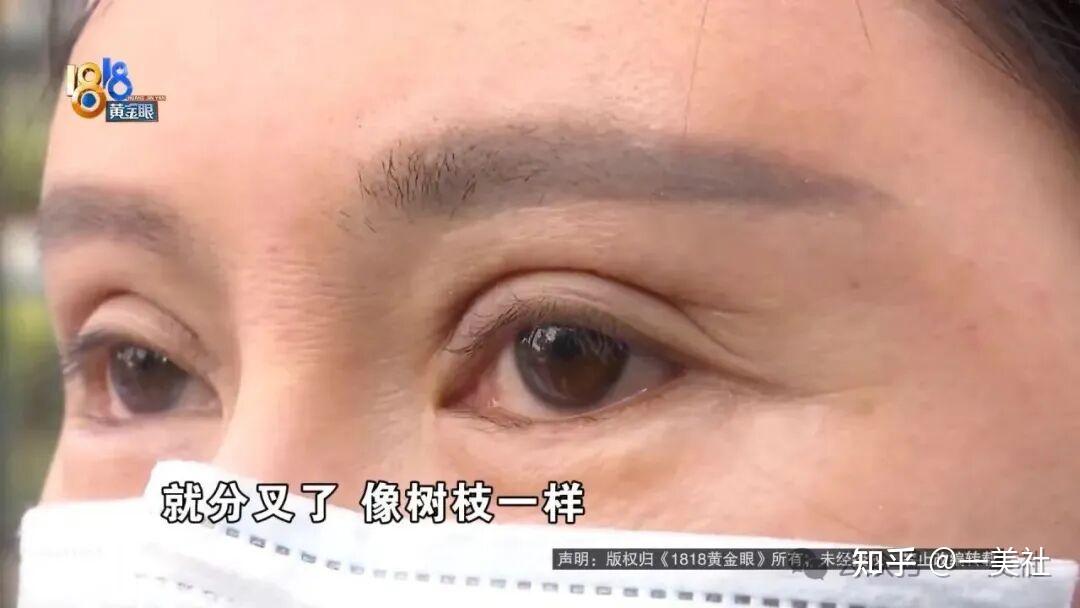 割双眼皮多出分叉线、抽脂后凹凸不平 维多利亚医美客诉不断(图6)