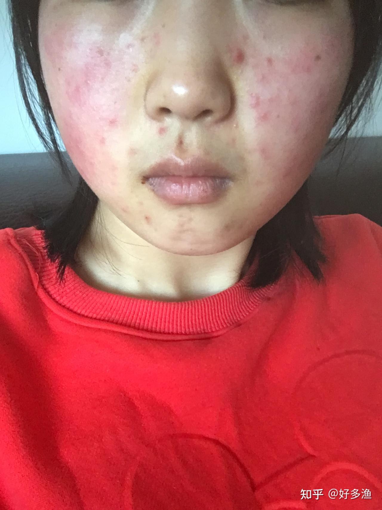 脸泛红怎么更快修复?