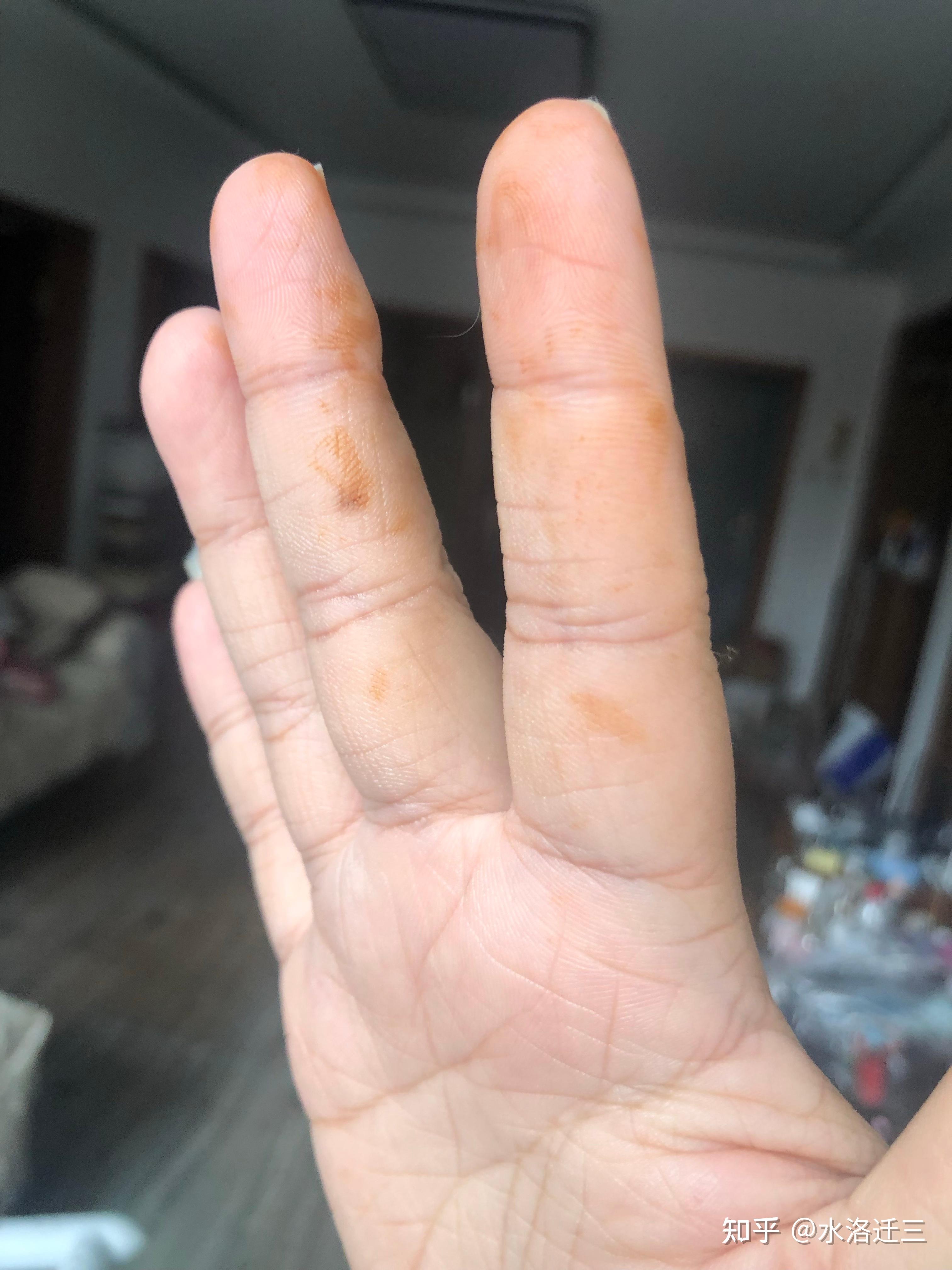 一觉醒来手上有铁锈一般的黄色块洗不掉