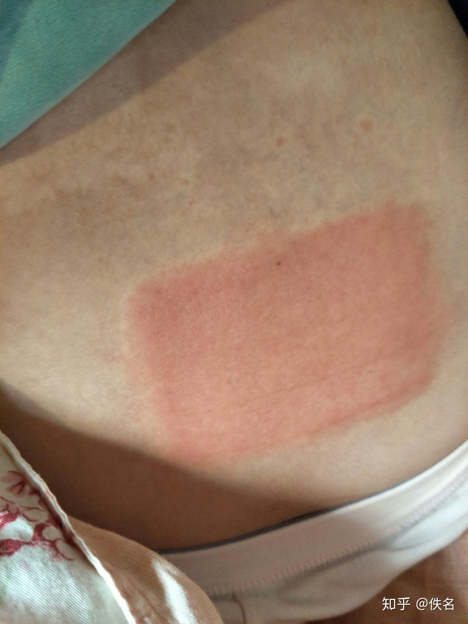 贴膏药过敏怎么办? - 知乎