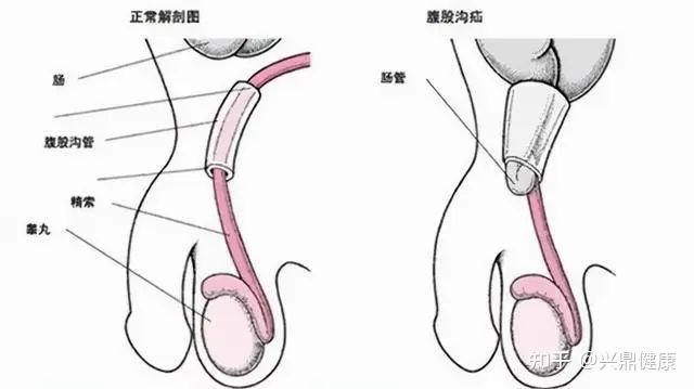 男生的阴囊 下垂图片