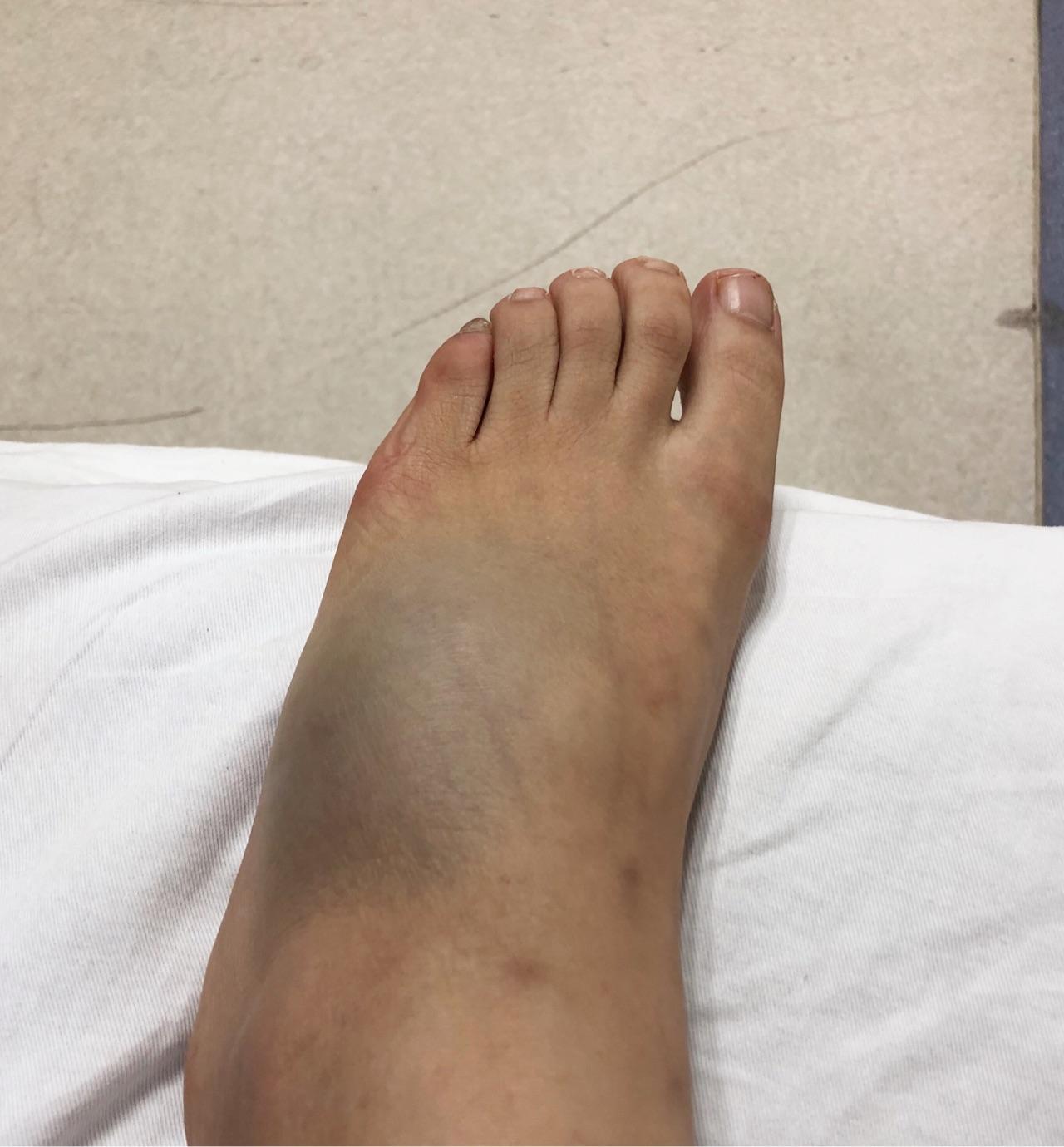 左脚第五根跖骨骨折