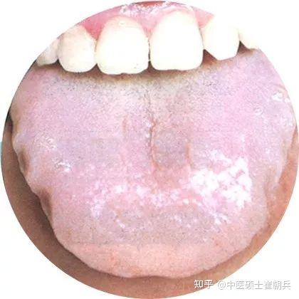 史上最全高清舌诊图谱,堪比教科书(收藏篇) - 知乎