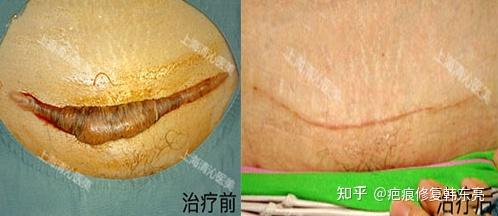 剖腹产疤痕你想问的全在这儿了,必看! - 知乎
