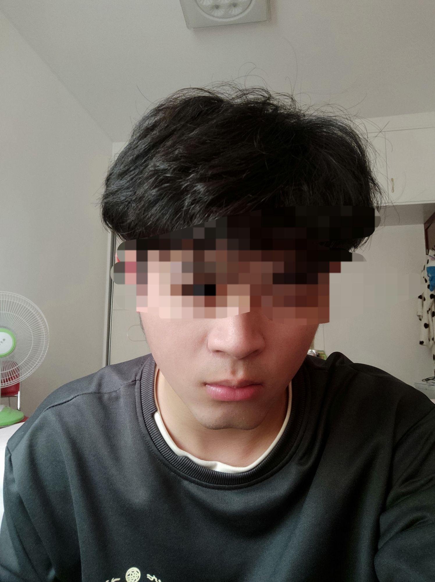 美人沟下巴也叫苹果下巴屁股下巴很难看怎么改善