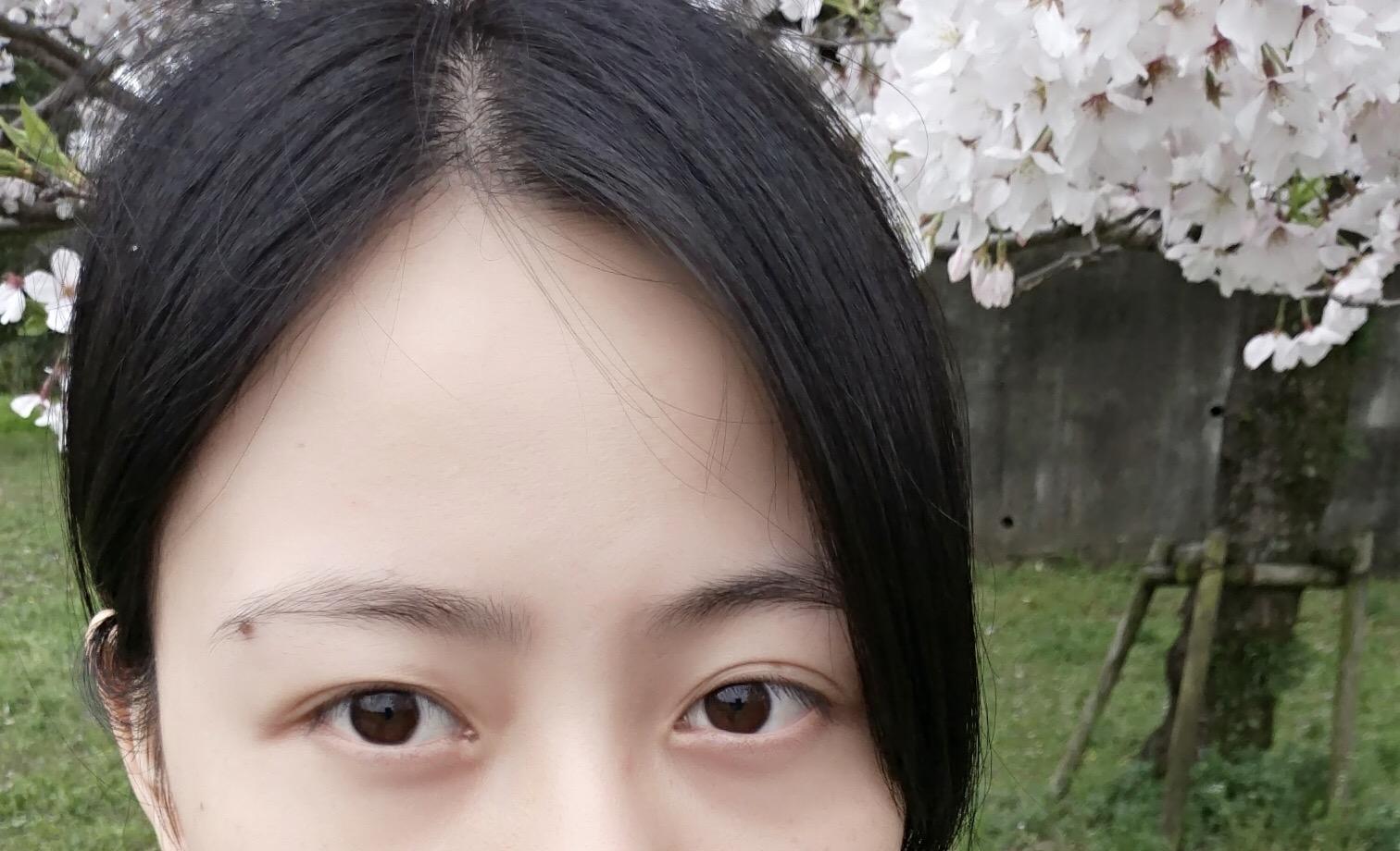 眼皮一单一双是怎样造成的?