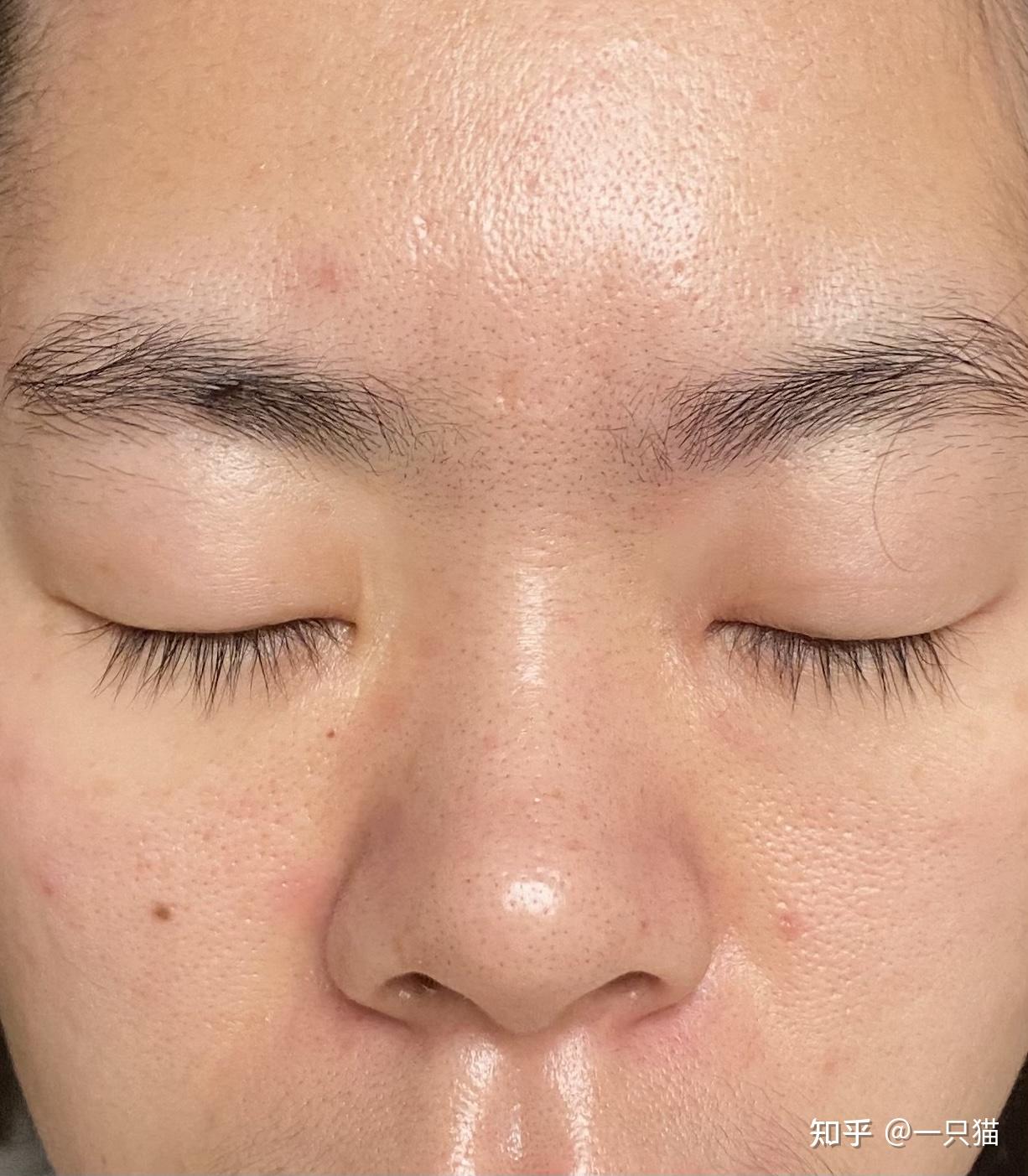 水杨酸可以去鼻子上黑头和t区毛孔粗大吗怎么使用一天几次