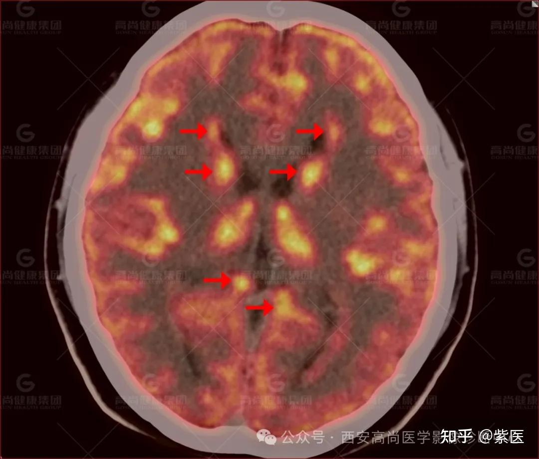 癫痫诊断：三种类型脑灰质异位在PET/CT典型表现 - 知乎
