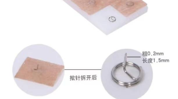 如何正确使用揿针（皮内针）并进行操作？ - 知乎