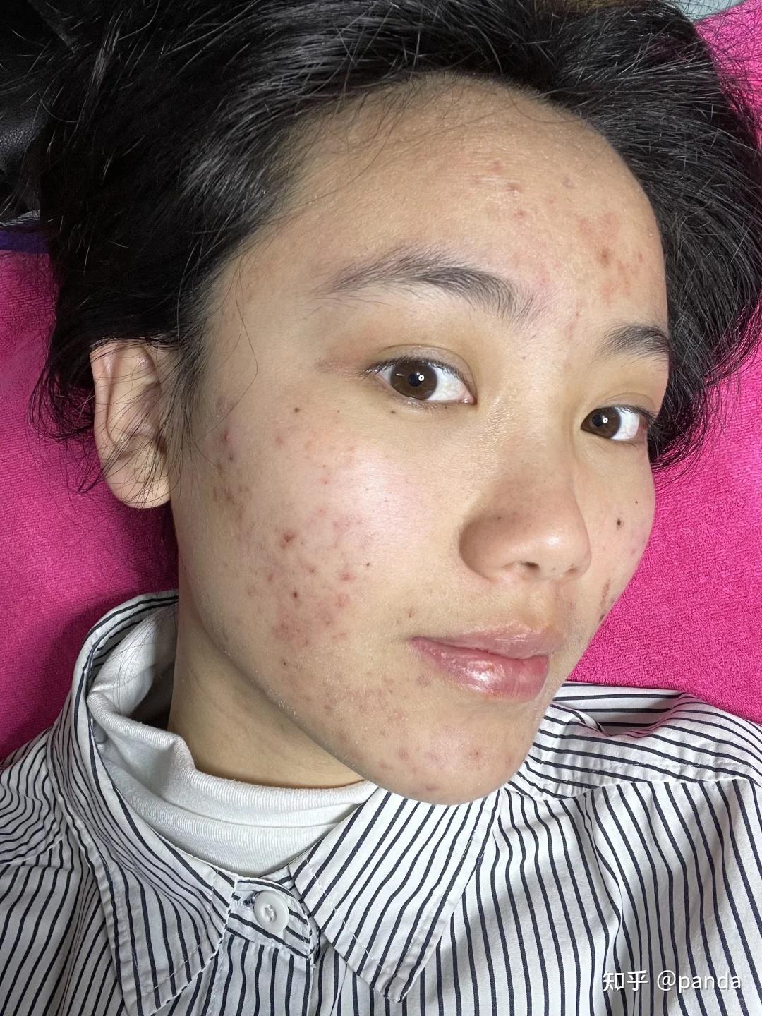 留下的深色印记,和β葡聚糖和泛醇配合,能更大程度的减少痘痘留下印记