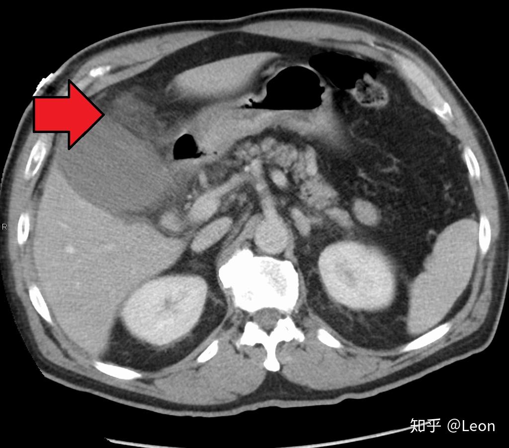 胆囊炎 Cholecystitis - 知乎