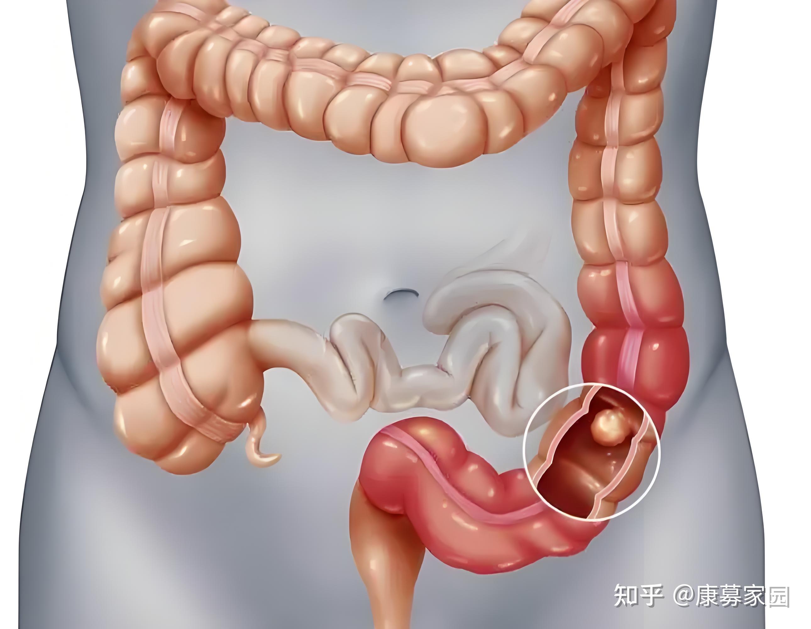 小肠癌图片