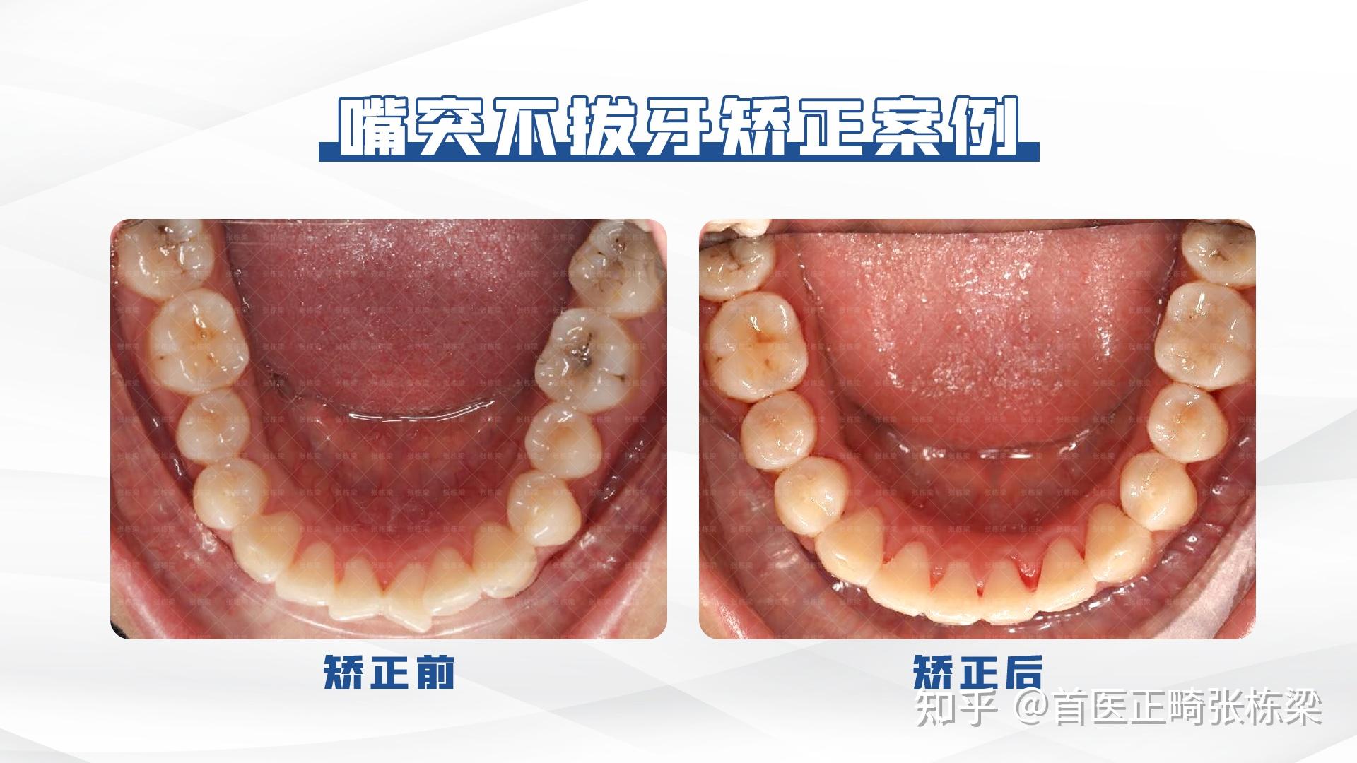 北京牙齿正畸 | 不拔牙正畸改善嘴突、没下巴，牙齿正畸逆旋下巴颏！