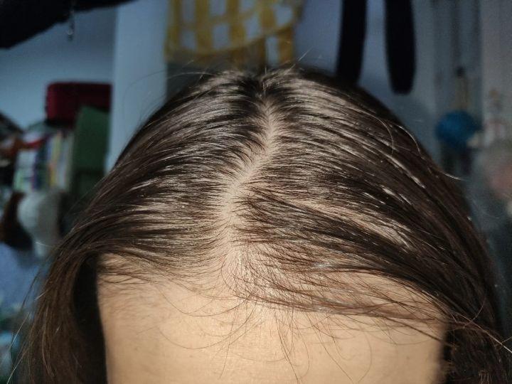 掉发严重特别是在摸头发发尾的时候,头发会自然脱落一大把,怎么回事?