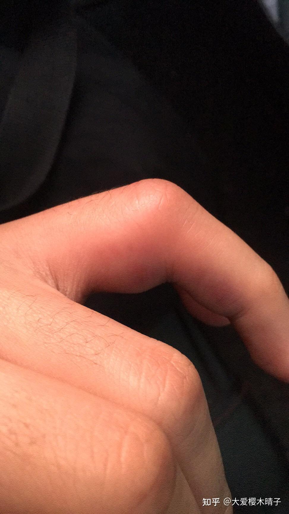 打篮球手指脱臼处理?